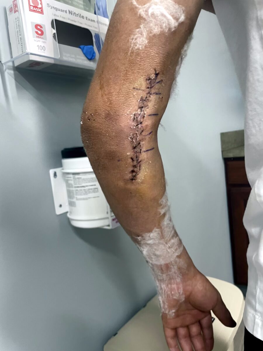 Broken arm and stitches